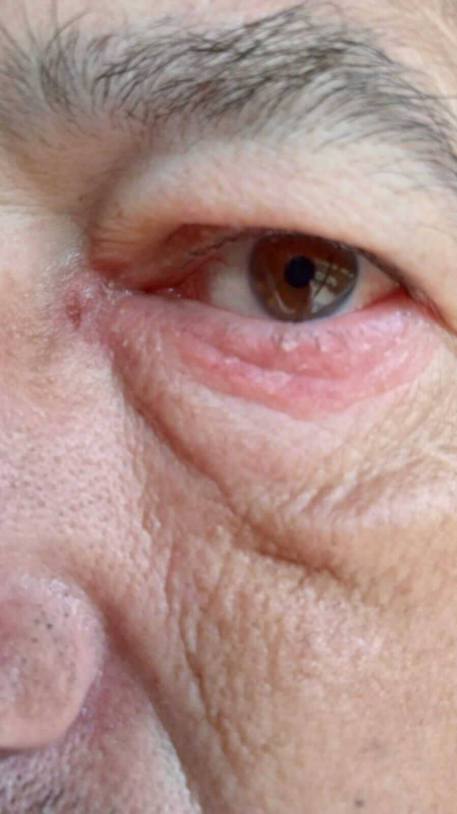 передача гонореи бытовым путем