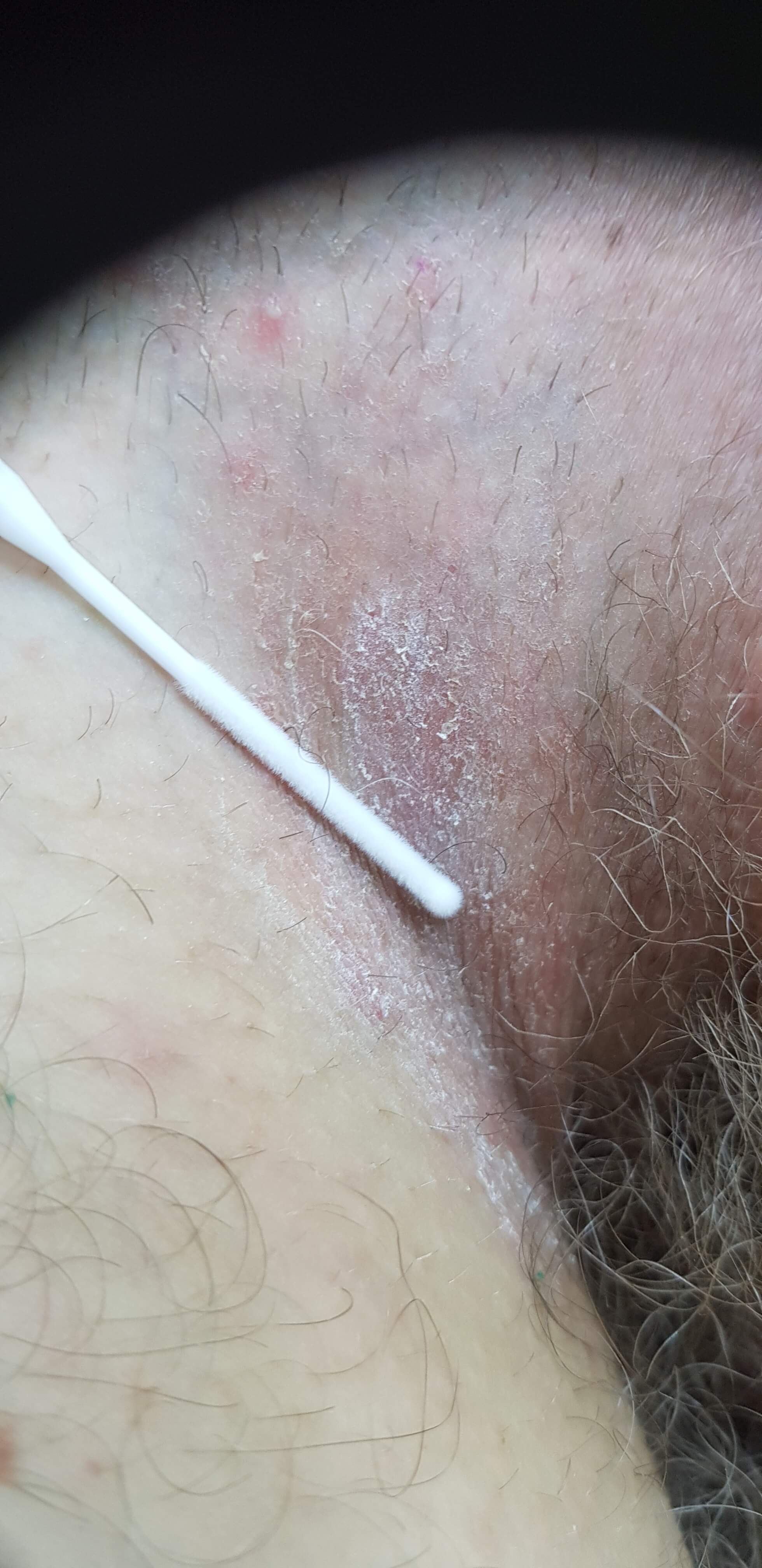 анализы посева на грибки молочницы