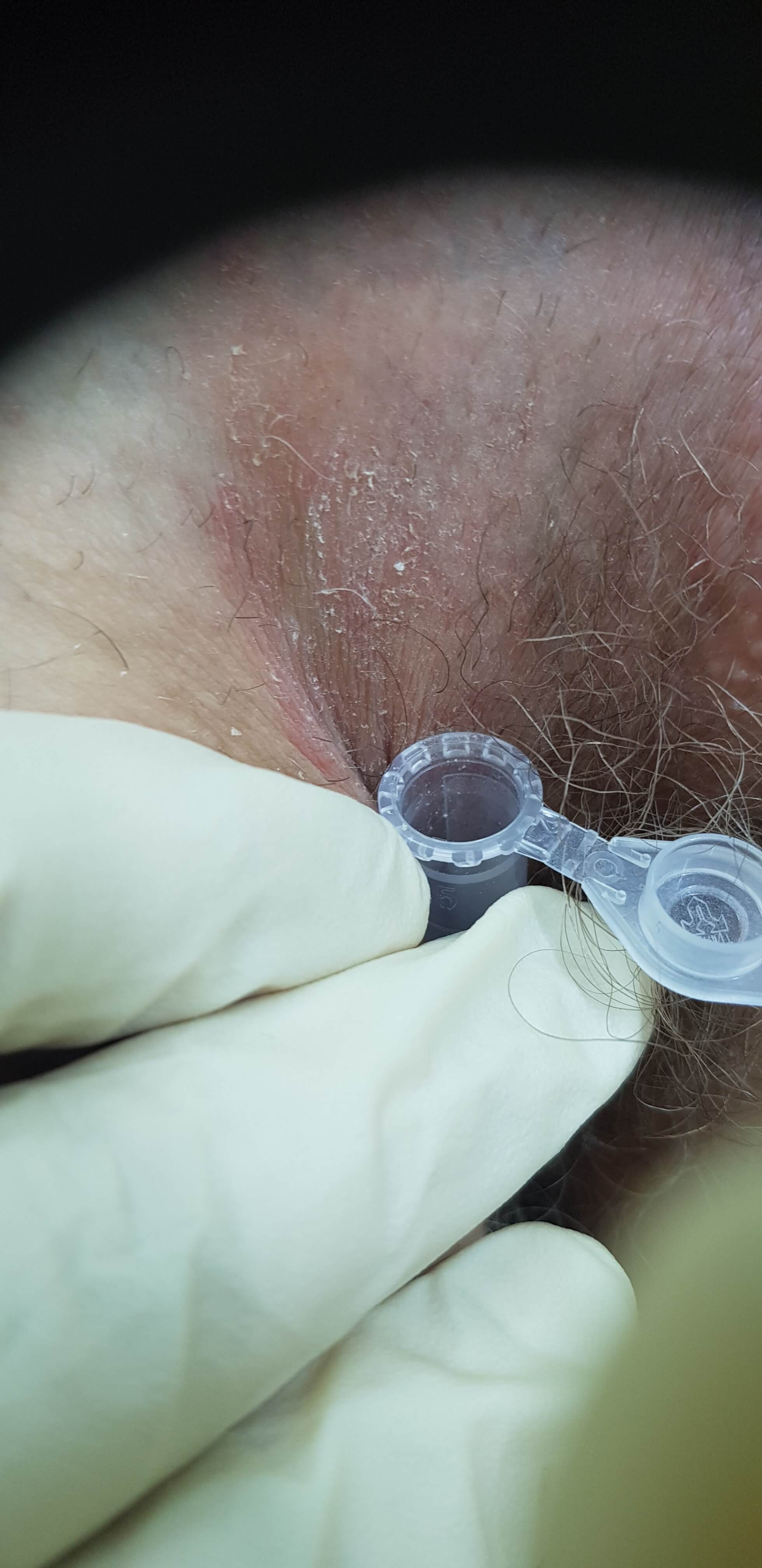 бак посев на грибок