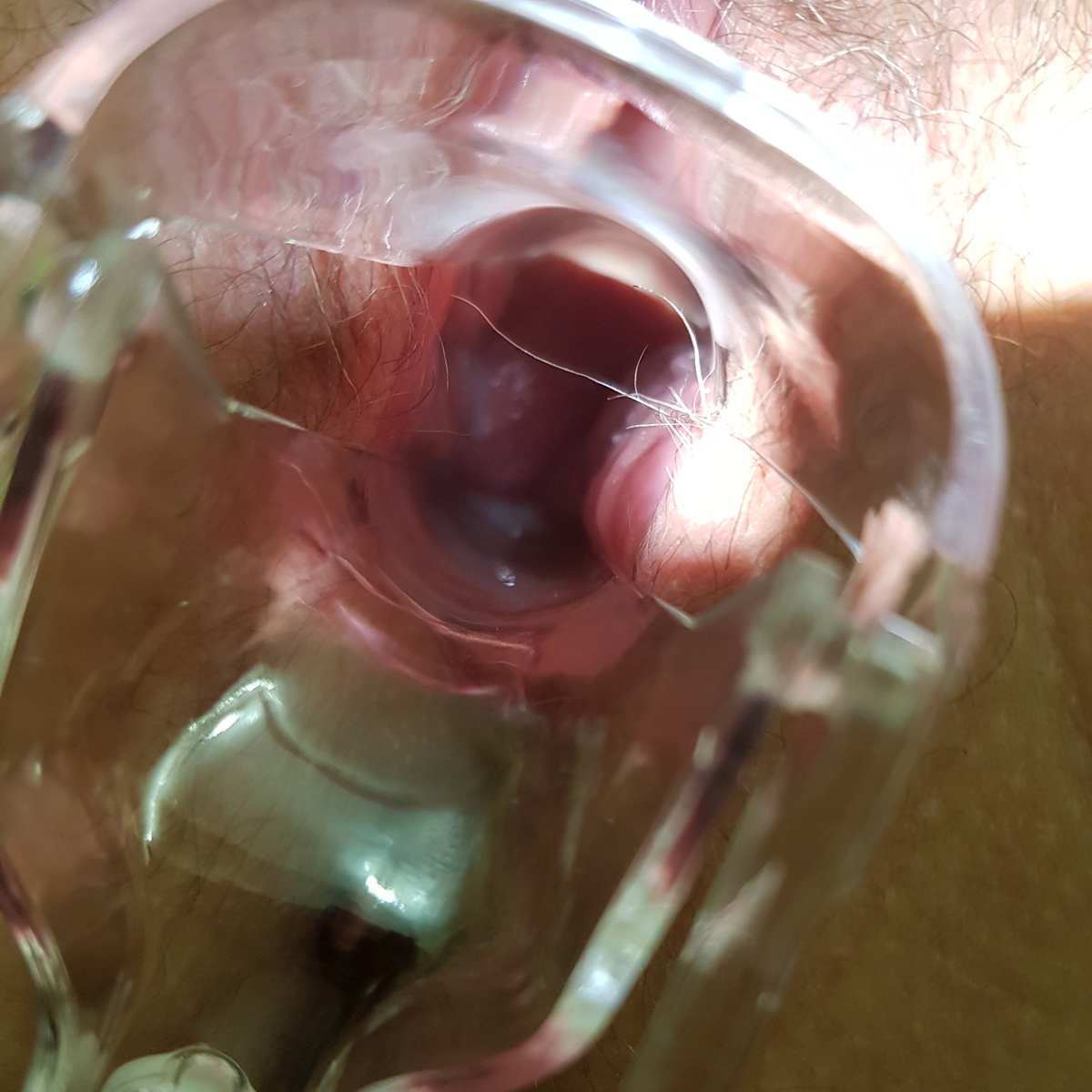 признаки цистита  симптомы воспаления мочевого пузыря