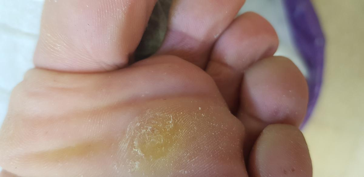 Удаление больших бородавок