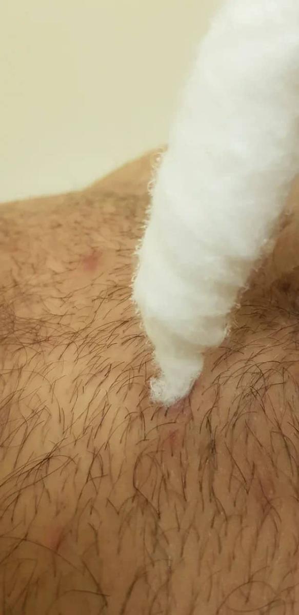 Вросшие волосы