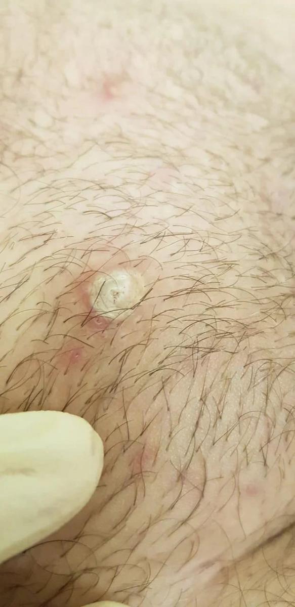 Вросшие волосы