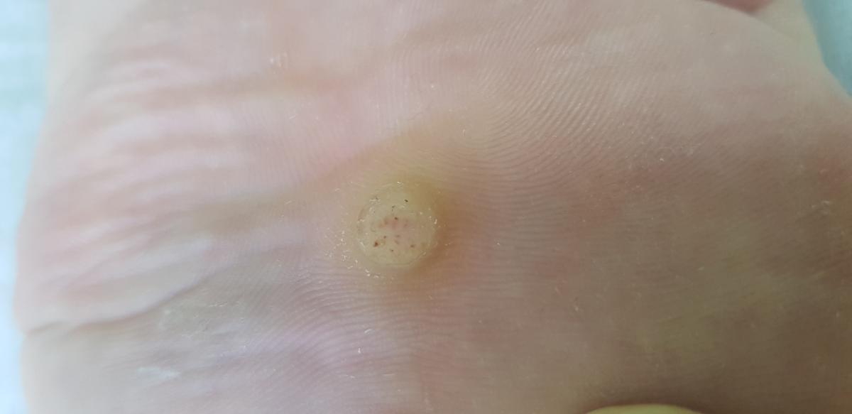 до удаления