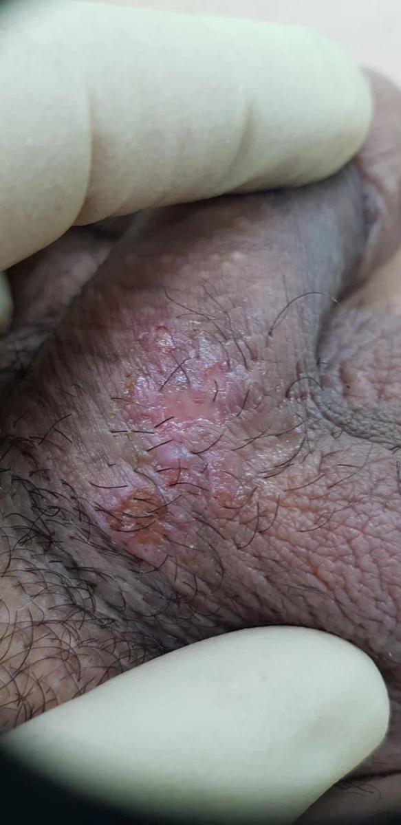 герпес 2го типа герпес 2го типа