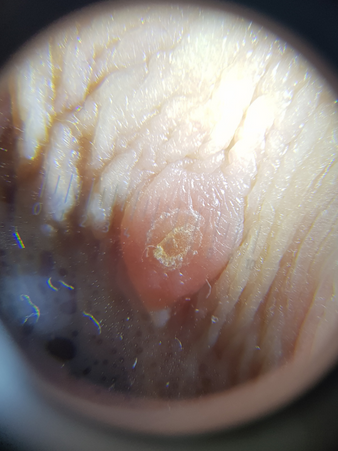единичный моллюск после гриппа, принятый пациентом за родинку в дерматоскопе
