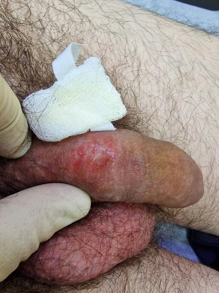 экзема-дюринг на члене с сильной экссудацией экзема-дюринг на члене с сильной экссудацией