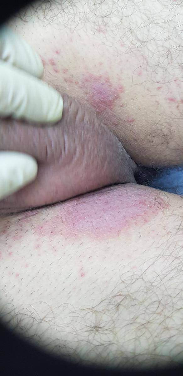 Шелушение в паху