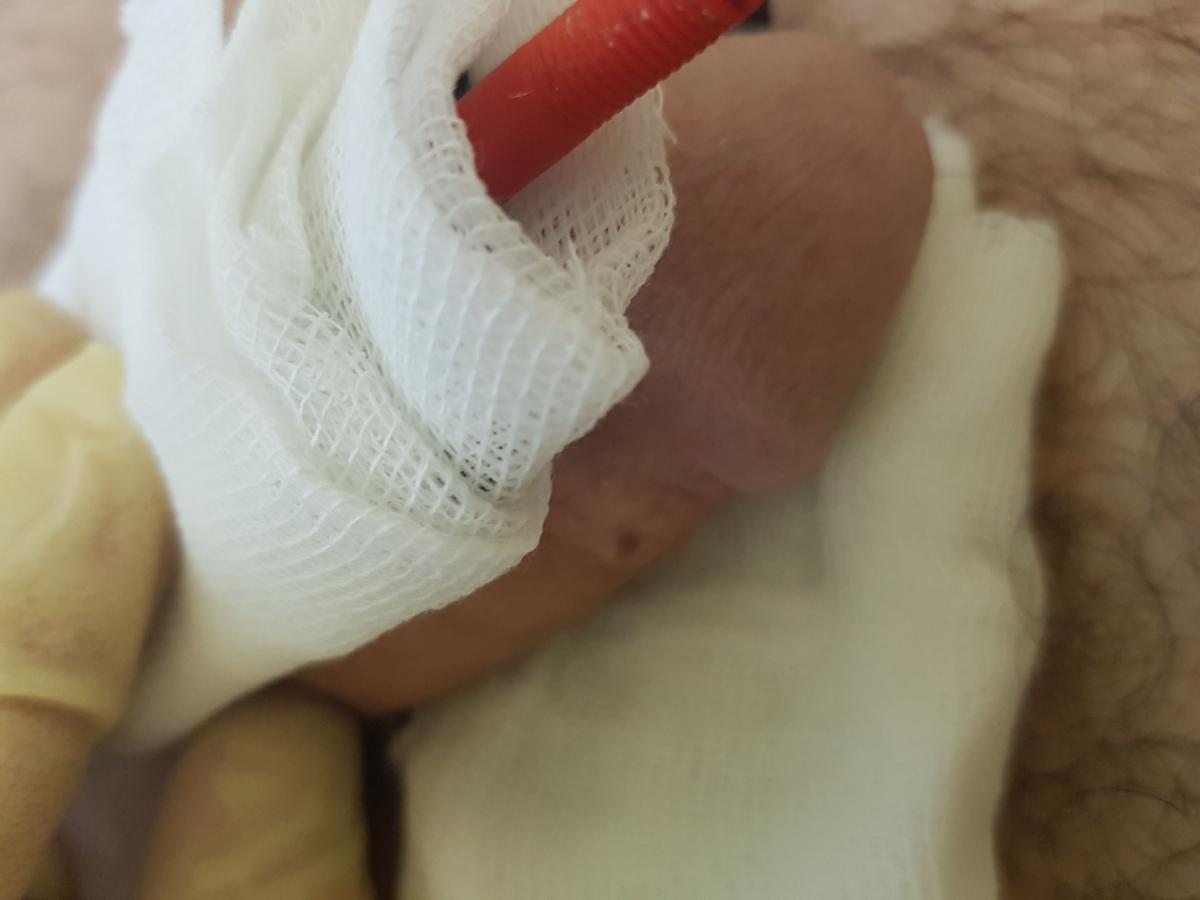 электрофорез при боли и воспалении в левом яичке электрофорез