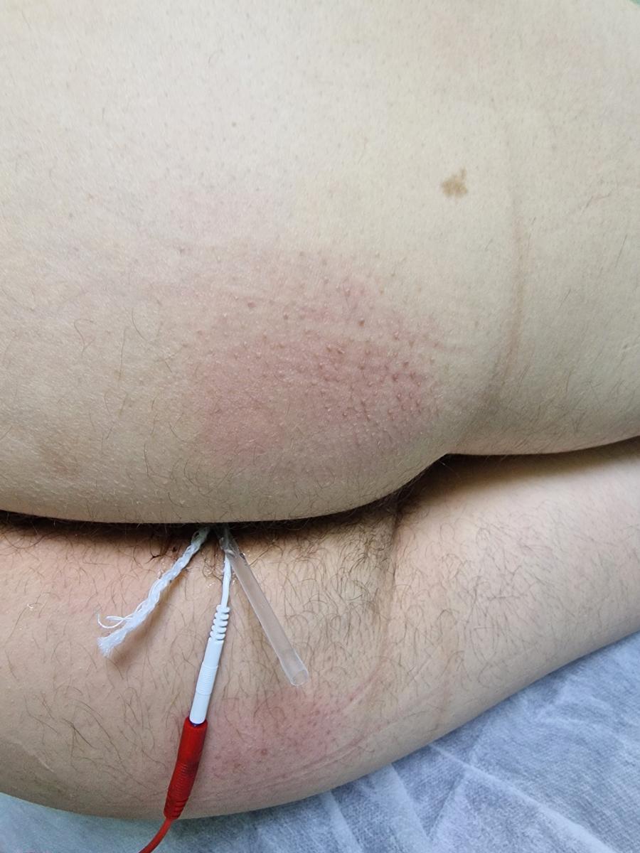 электрофорез