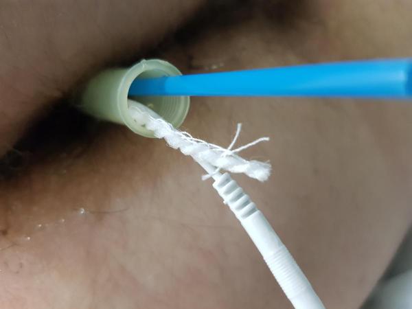 электрофорез в простату электррфорез