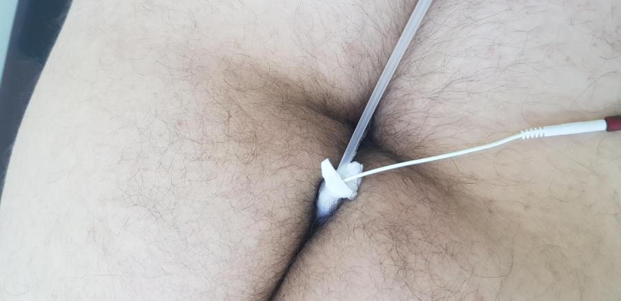 электрофорез анально колликулит у мужчин симптомы