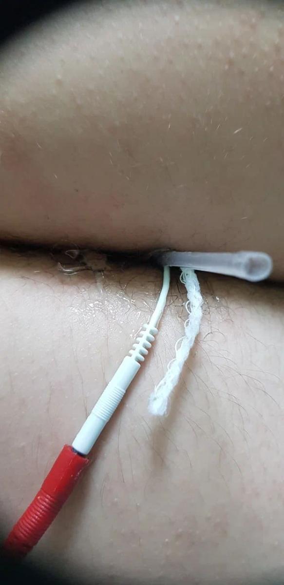 Электрофорез