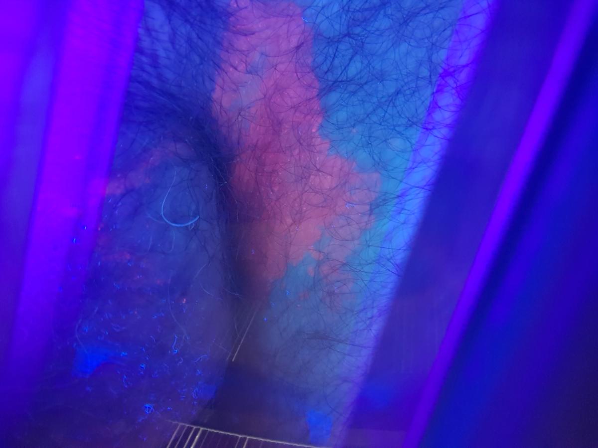 паховая эритразма