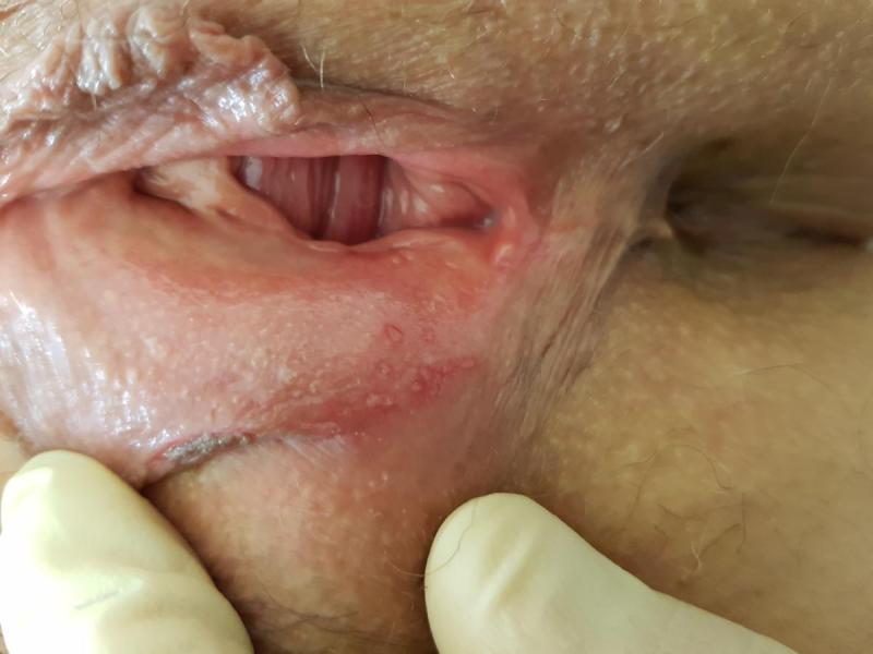 эрозии при герпесе признаки герпеса во влагалище