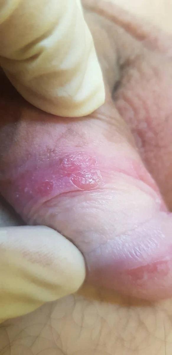 эрозивный баланопостит эрозивный баланопостит