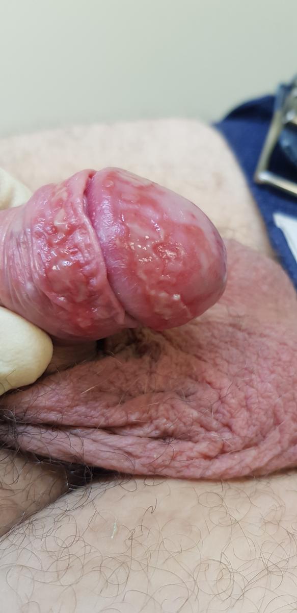 эрозивный баланопостит до лечения