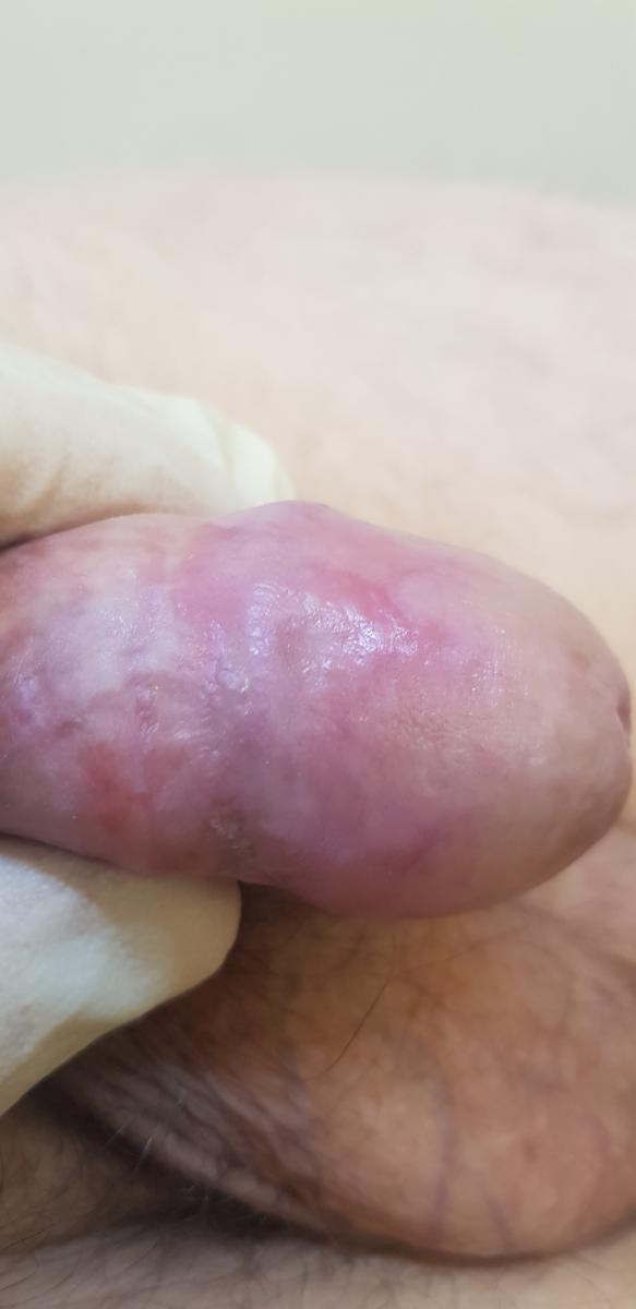 после лечения эрозивного баланопостита полсле лечения