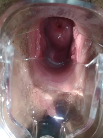 фото ВПЧ инфекция шейки матки и малых половых губ