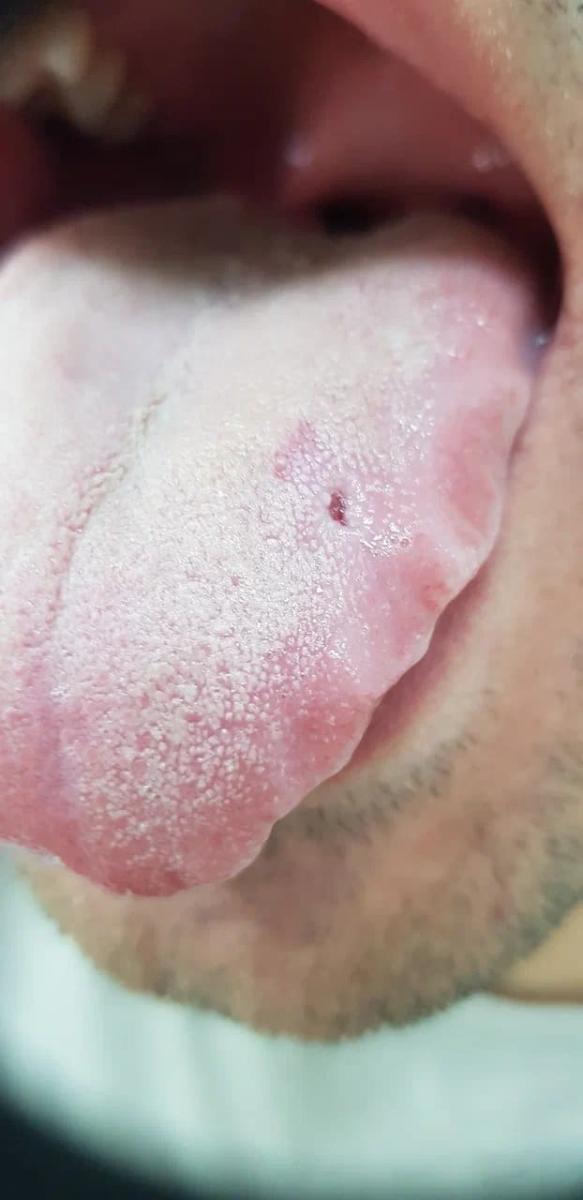 фиброма языка фиброма языка