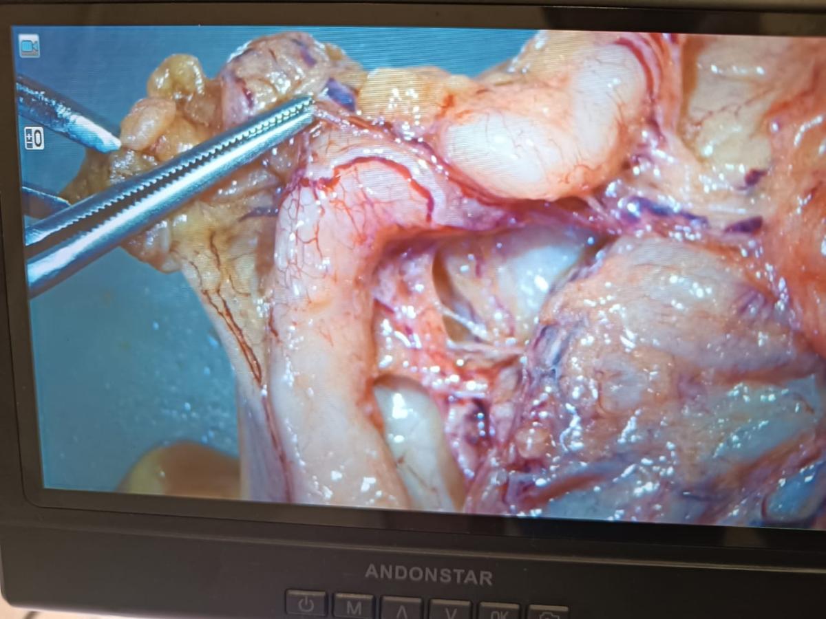 фиброз простаты