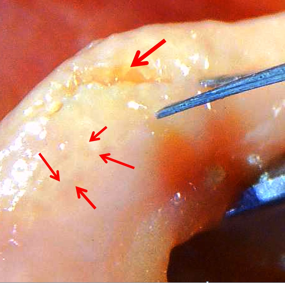 фиброз простаты фиброз предстательной железы