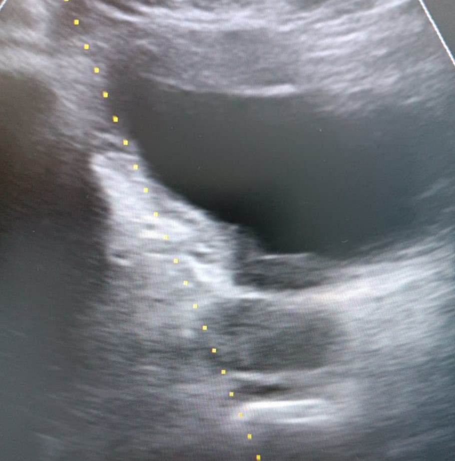 воспаление простаты и уретры