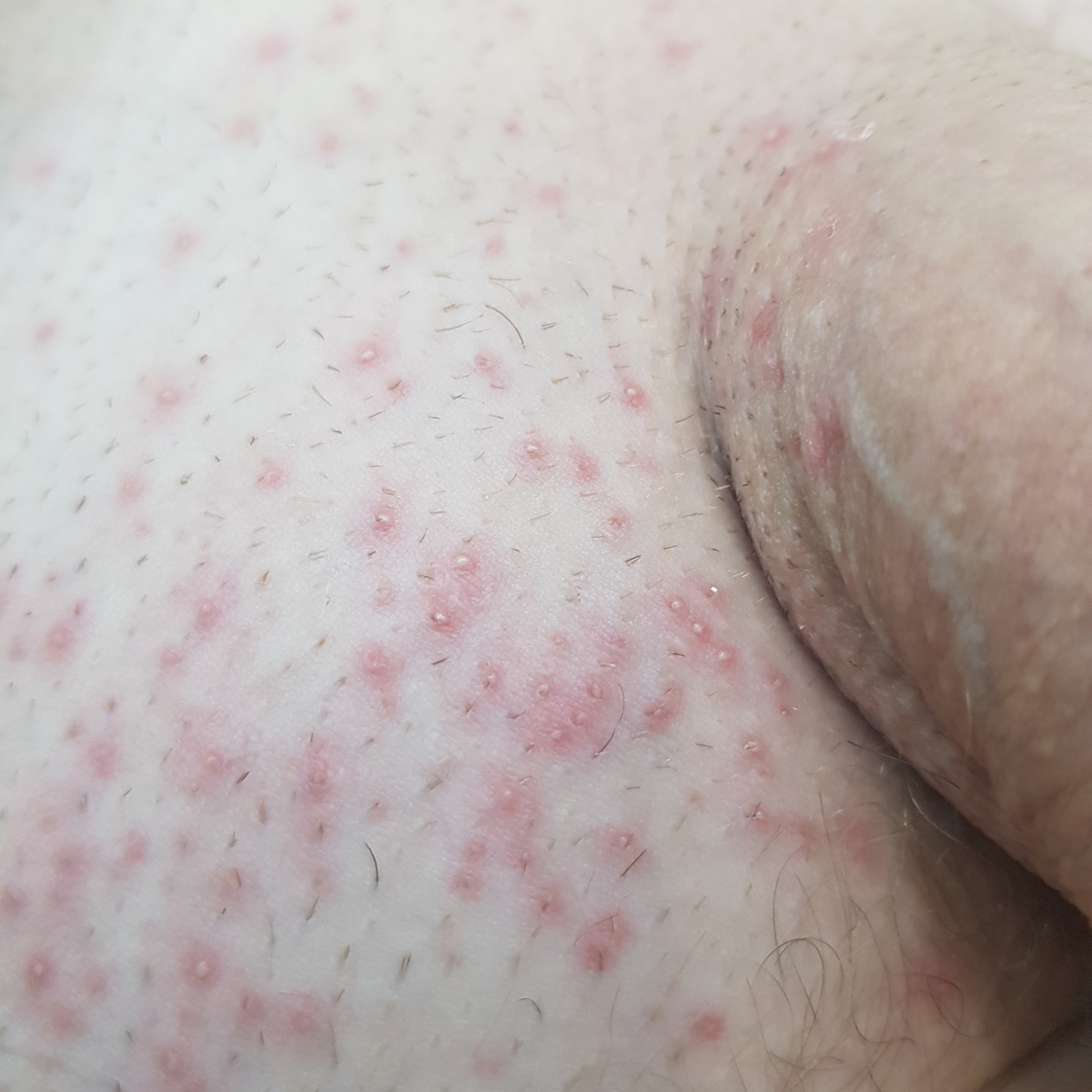 лобок после бритья после бритья болит лобок