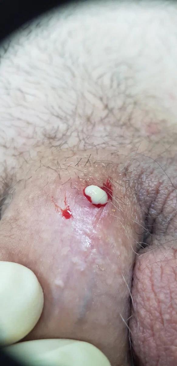 вскрытие язвы