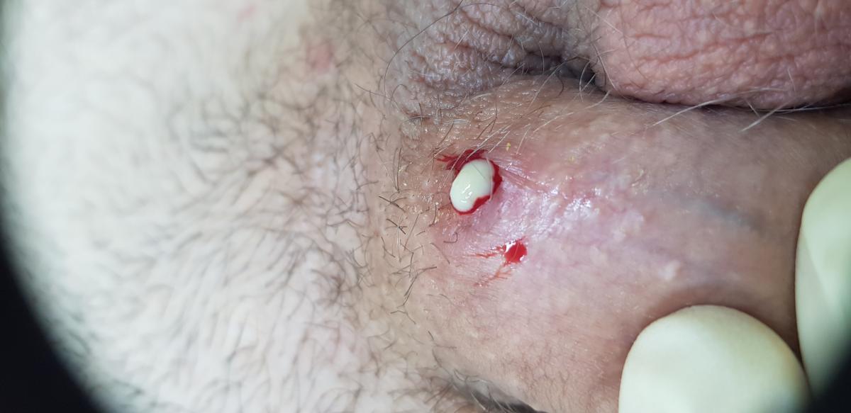 вскрыт фолликул