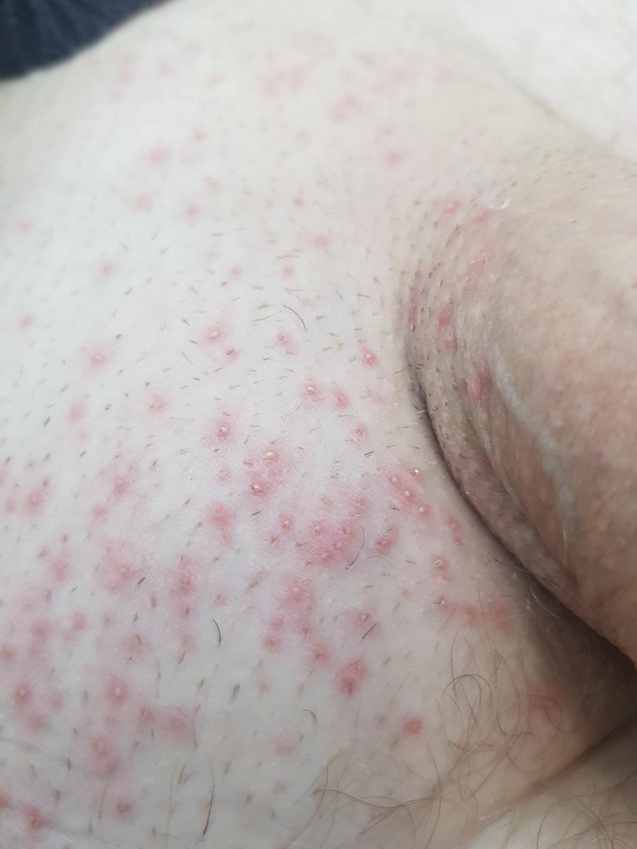 фолликулит