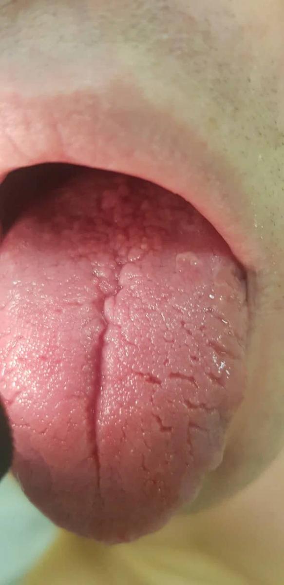 папулы на языке папулы на языке