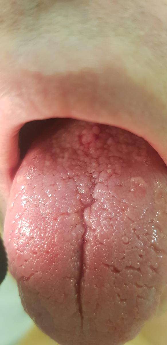 пятна сифилиса