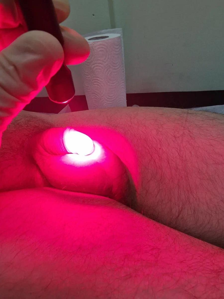 Фотодинамическая лазерная терапия твердого шанкра