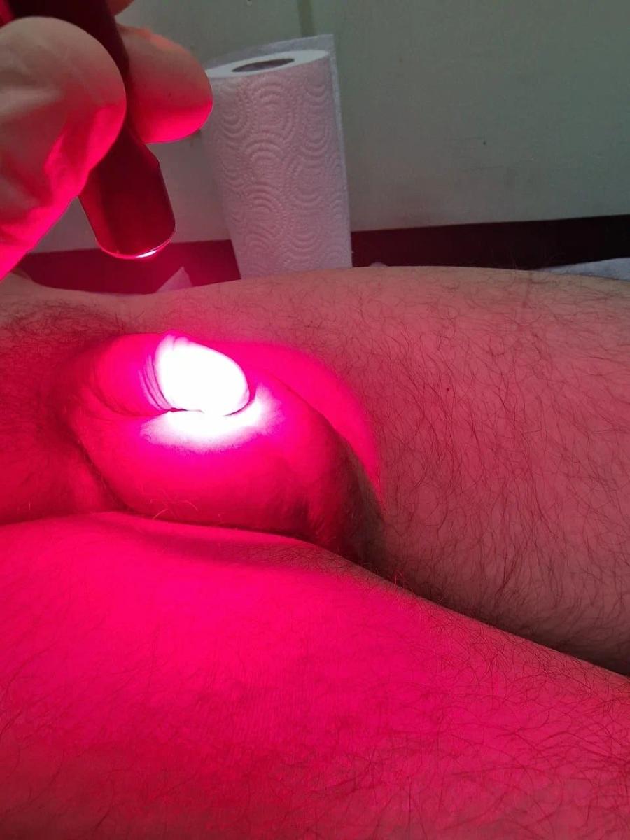 Фотодинамическая терапия уретры