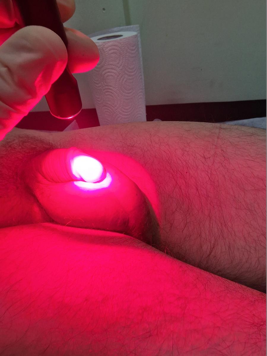 фотодинамическая терапия фтд