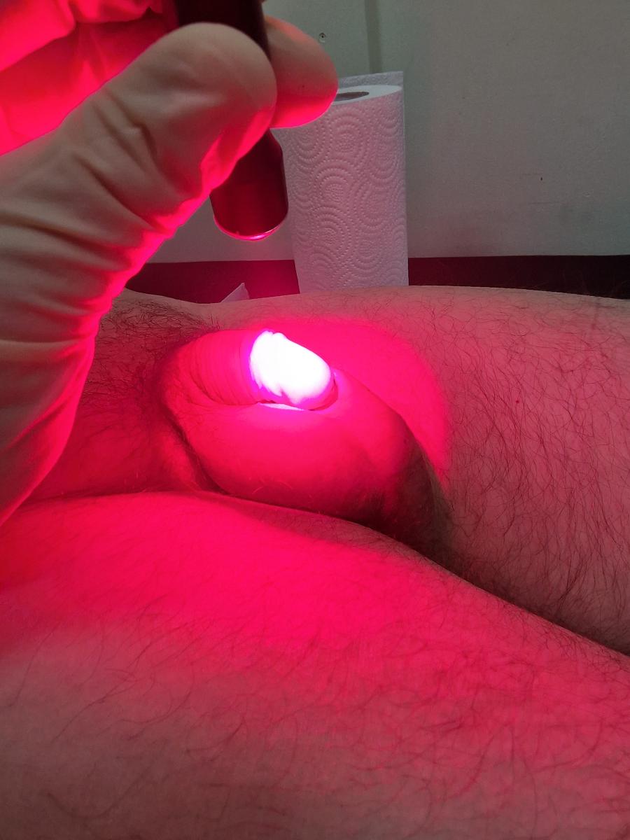 фотодинамическая терапия фтд