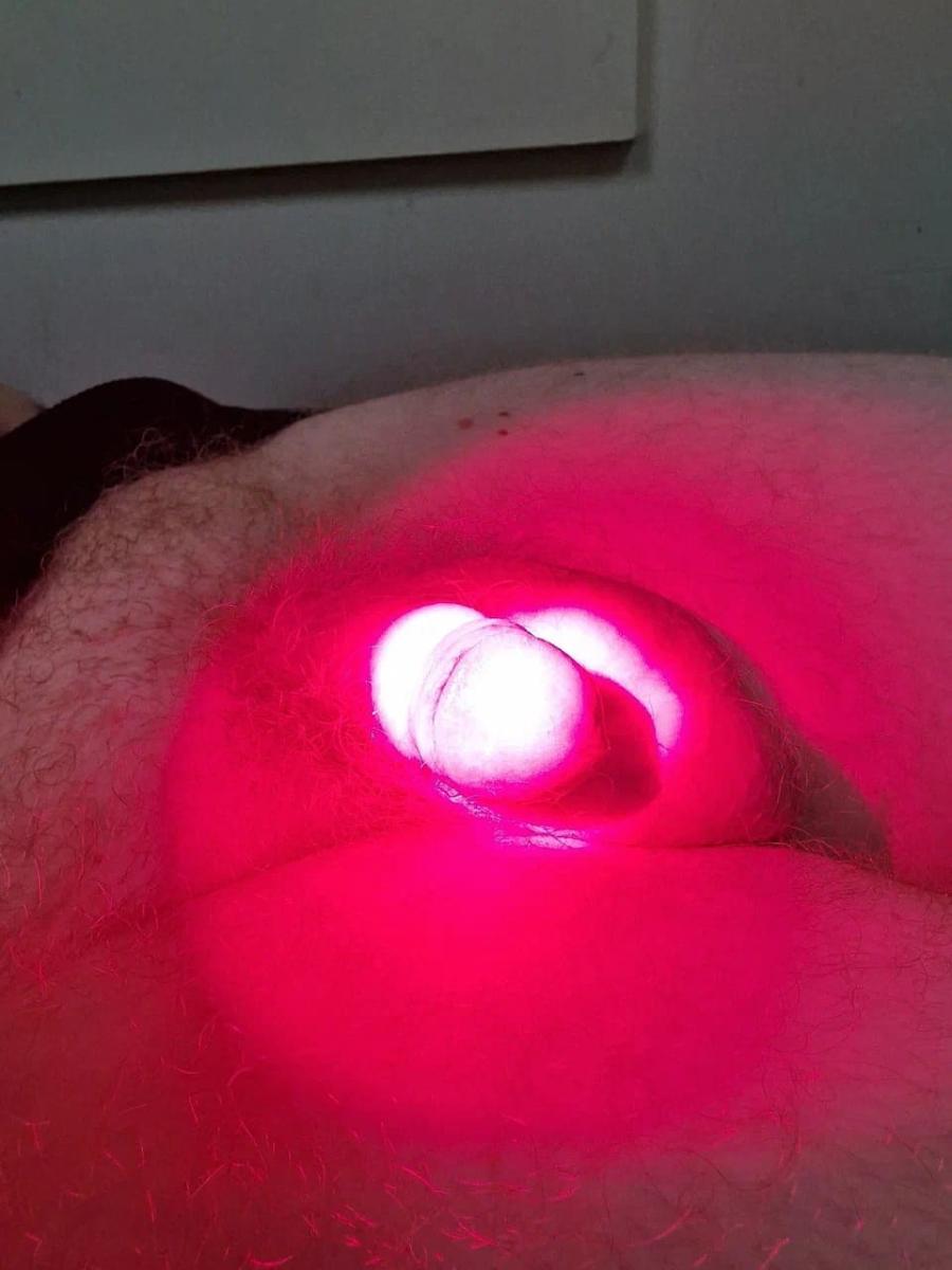 Фотодинамическая терапия уретры Фотодинамический лазер