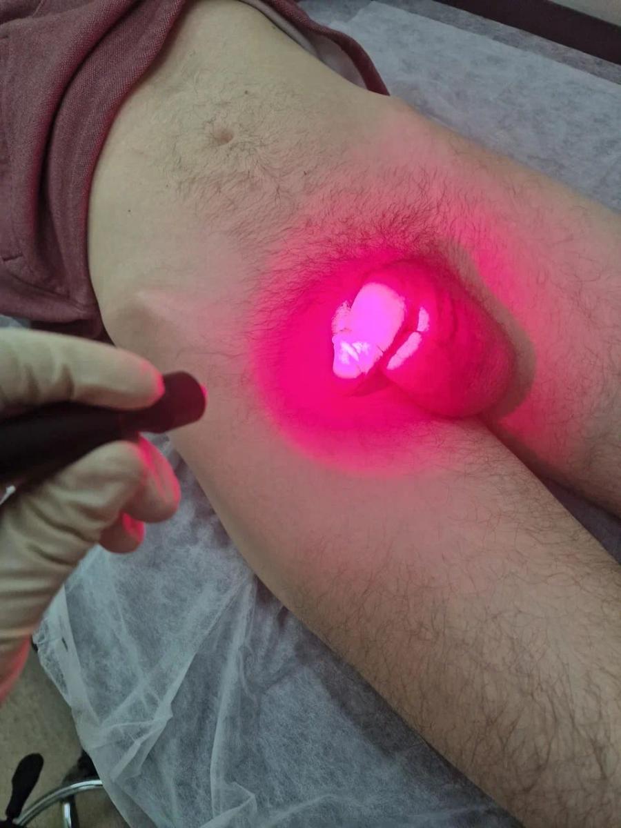 фотодинамический лазер на область паха фотодинамический лазер на область паха