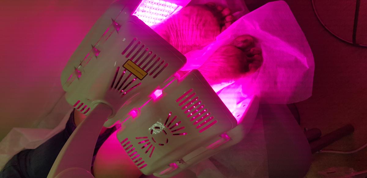 фотодинамическая терапия подошвенных бородавок