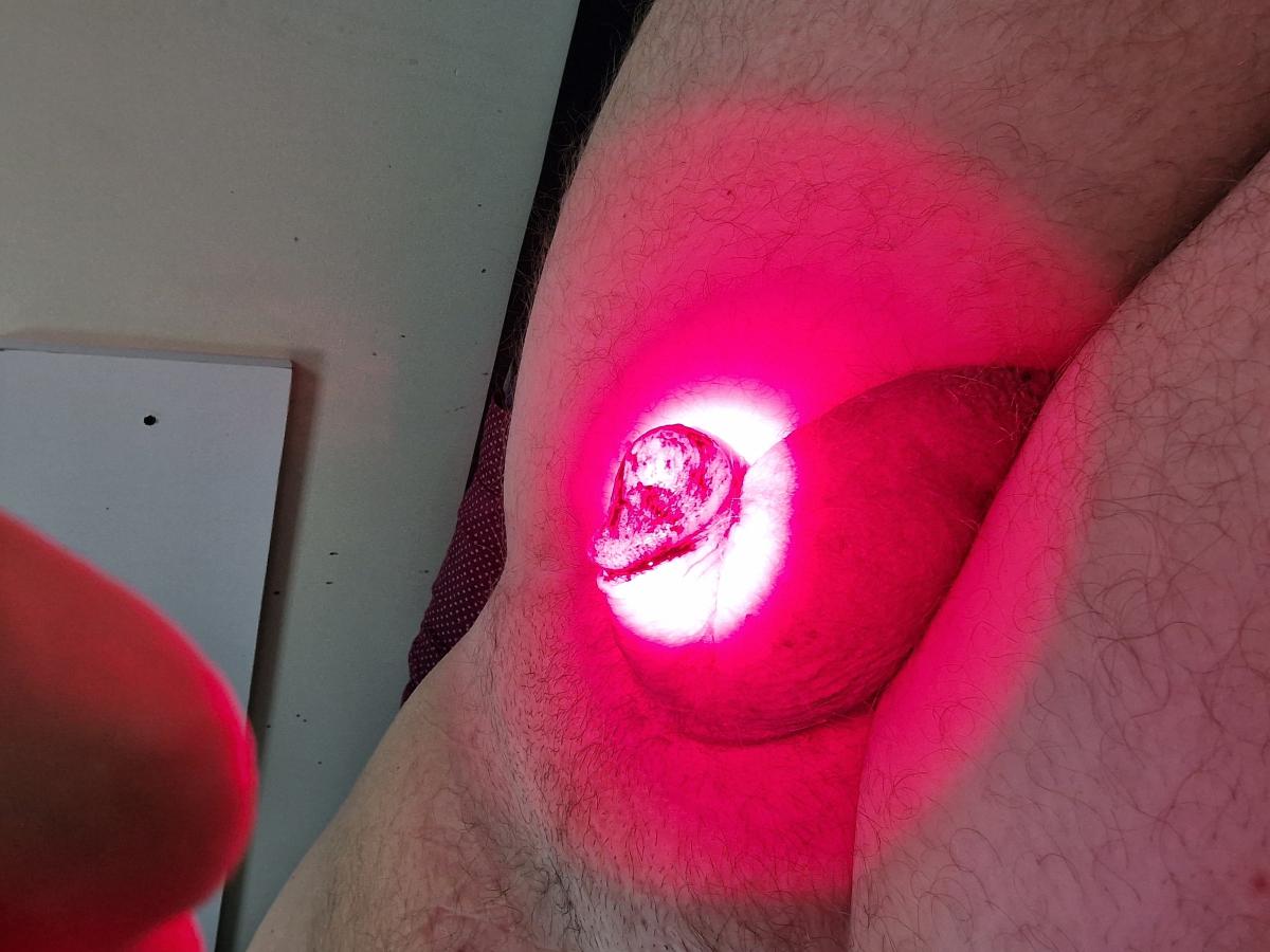 фотодинамическая терапия ФТД