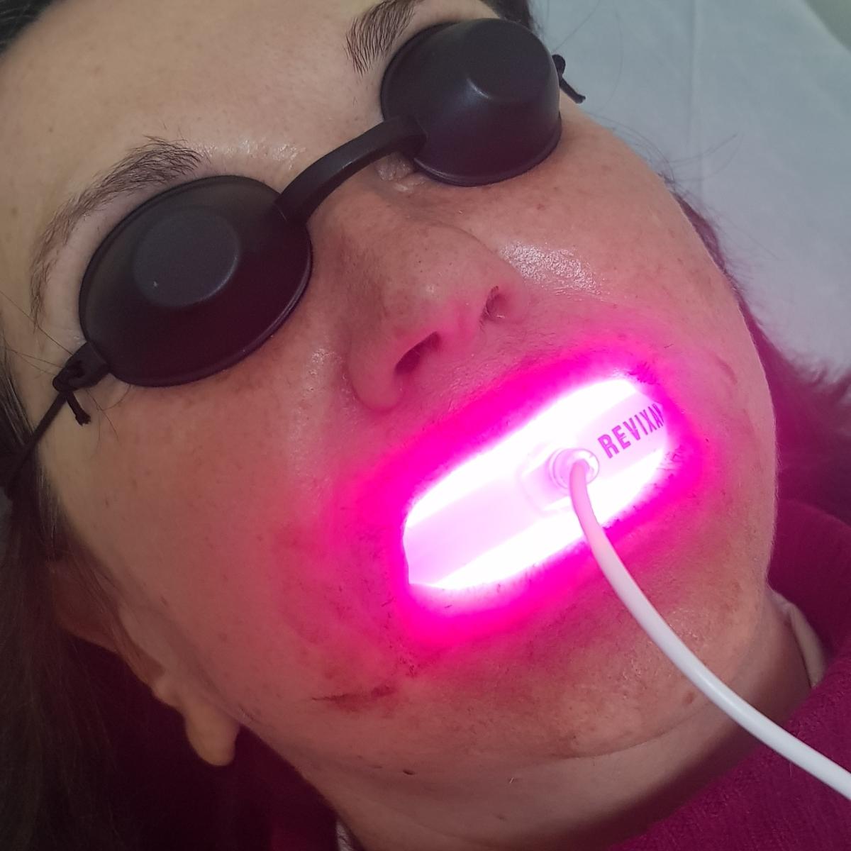 Фотодинамика полости рта Фотодинамическая терапия полости рта