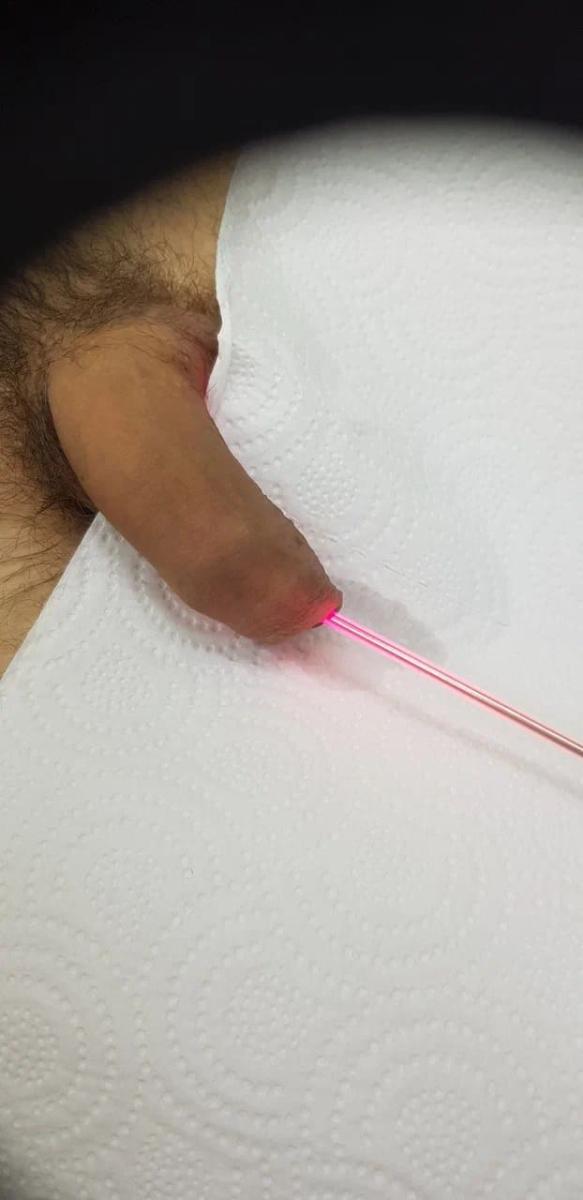 Фотодинамическая терапия уретры