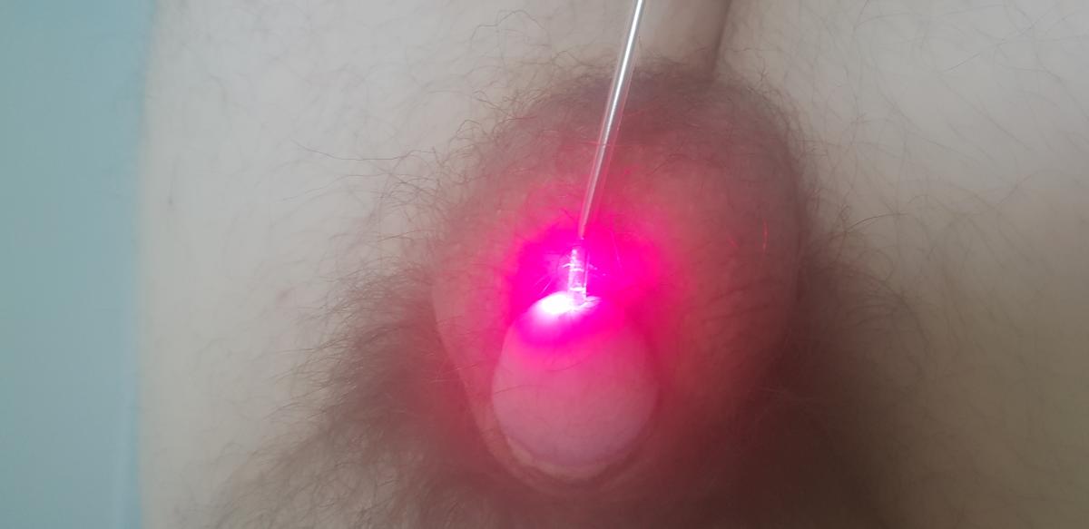 фотодинамика уретры фтд