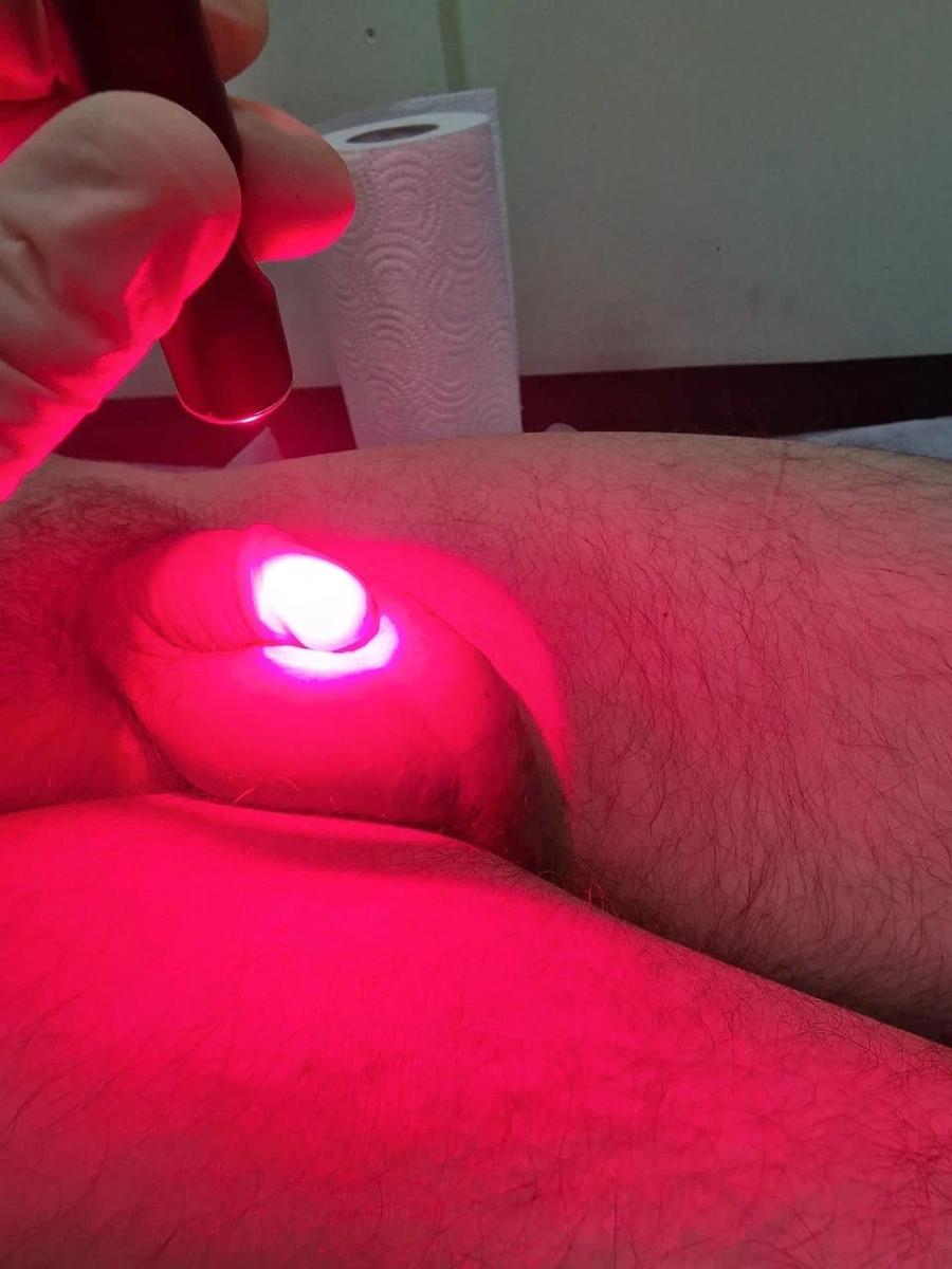 Фотодинамическая терапия уретры