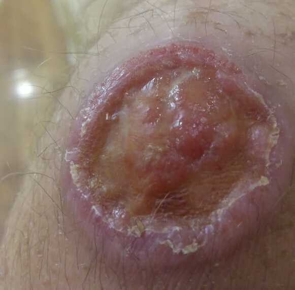 Гангренозная пиодермия Гангренозная пиодермия