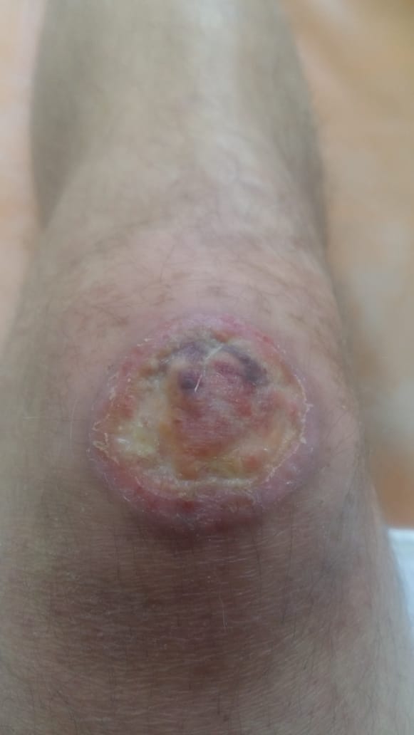 артрит поражение суставов при микоплазме гениталиум