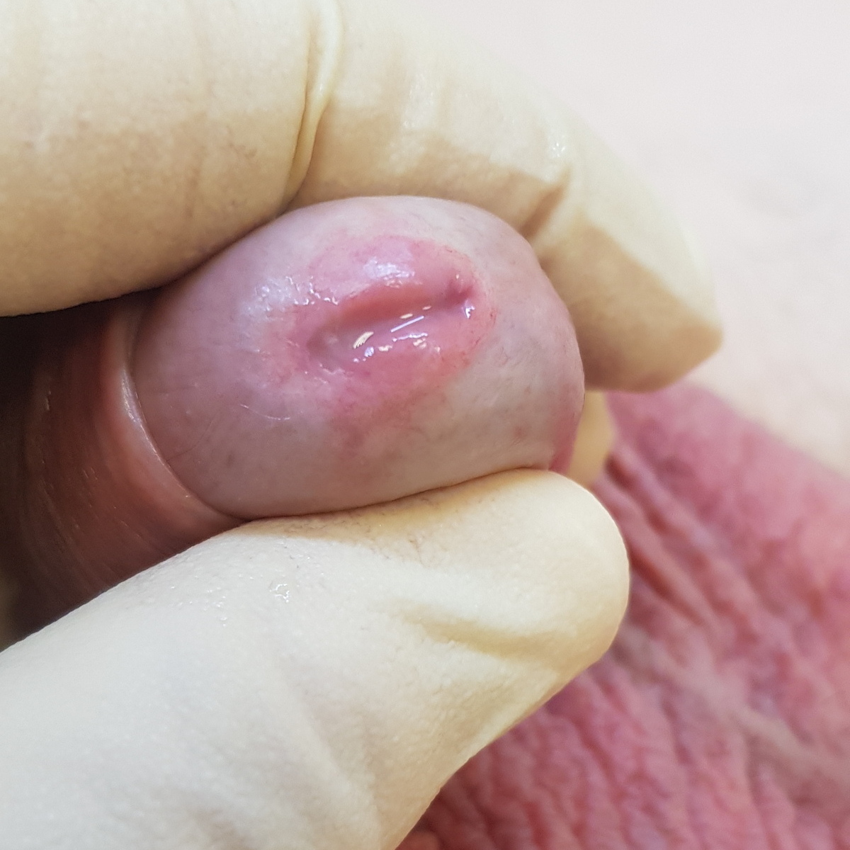 симптомы гонореи признаки гонореи