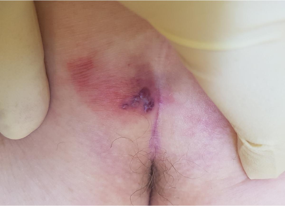 корочки герпеса герпетические везикулы на ягодицах