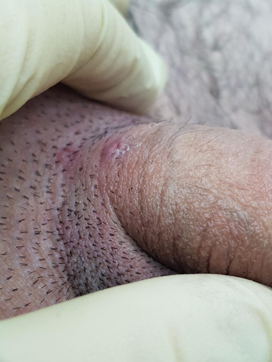 герпес на лобке болит лобок при герпесе